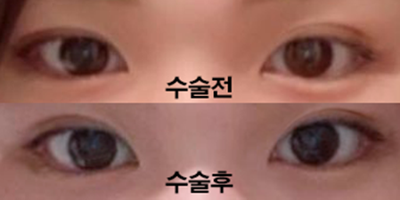 쌍꺼풀 재수술 3개월차입니다!