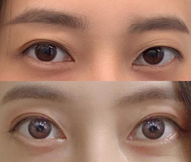 재수술 6개월차 후기