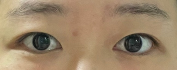 절개 쌍꺼풀 앞트임 5개월차 후기입니다