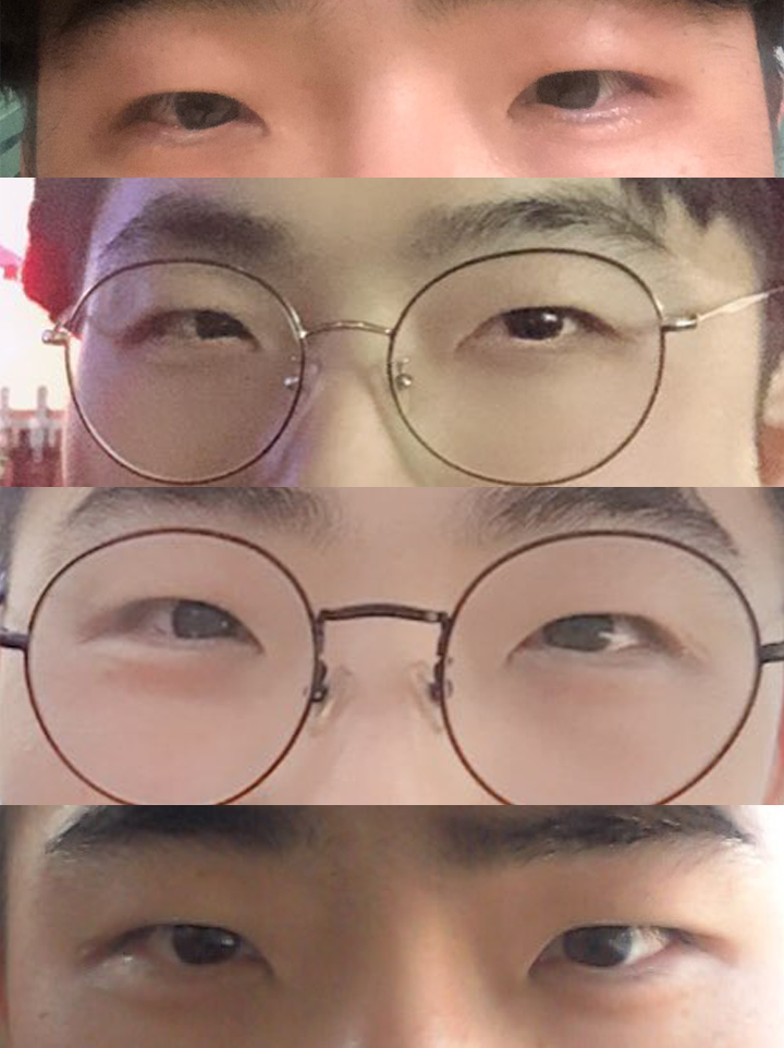 눈매교정(절개)+앞트임 후기