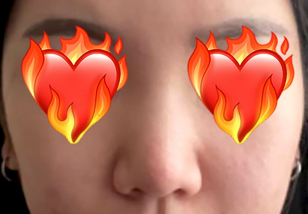 복코가 고민이라 베리굿에서 코성형을 했어요