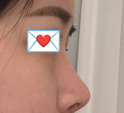 베리굿 성형외과 임영민 원장님께 코재수술 받았어요!