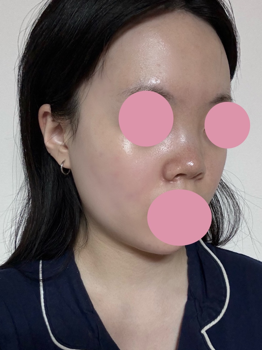 워낙 짧고 낮은 코였는데 확실하고 자연스럽게 수술 되어서 만족합니다 :)