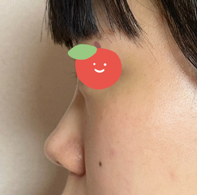 기능코 가능한곳 7곳은 넘게갔는데 다 안된다고 했는데 베리굿  성형외과에서는 축농증까지 가능하다고 해주시고 설명도 잘해주셔서 계약했습니다.