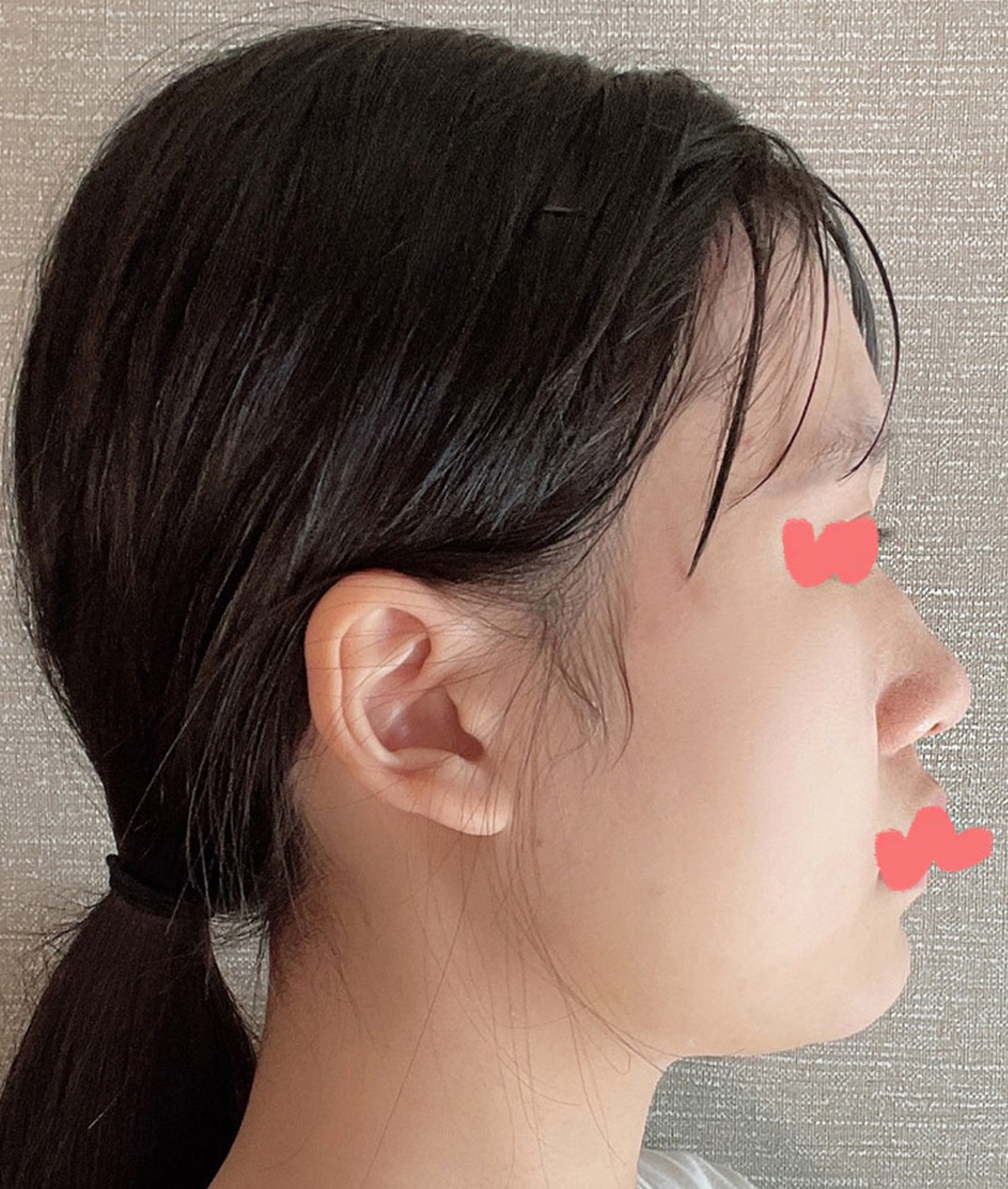 너무 만족하고요 자존감도 확 올라갔어요 코 성형 고민이신 분들은 그냥  하는 게 좋은 것 같아요