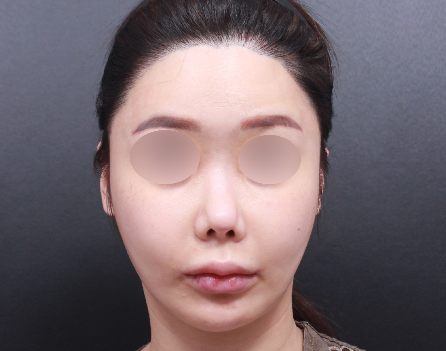 전 수술 여기서만 합니당..   원장님들도 책임감 있으시고 직원분들이 진짜 친절하세요