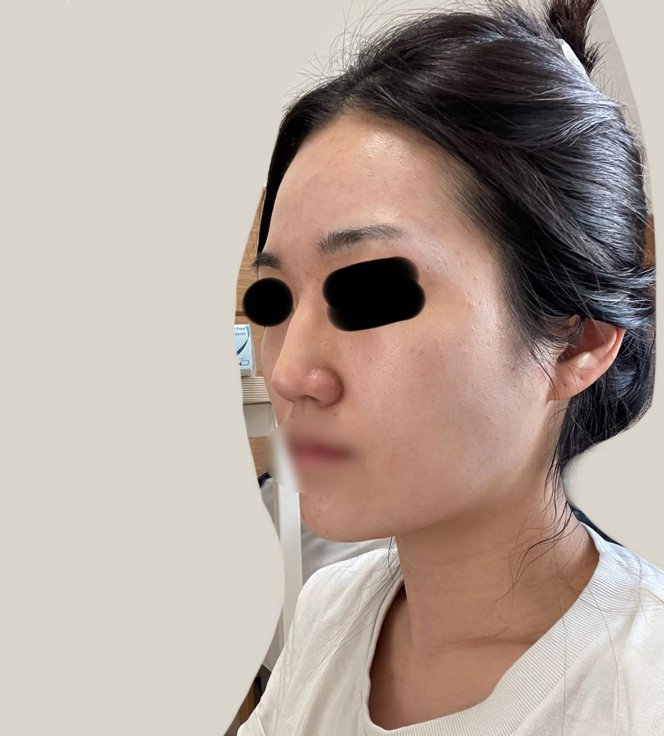 시술 5개월차 입니다.