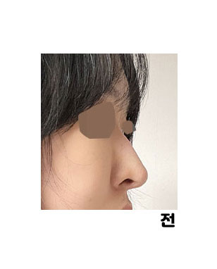 최근에 비염이 너무 심해져서 병원알아보다가상담받고 바로 수술예약했어요!