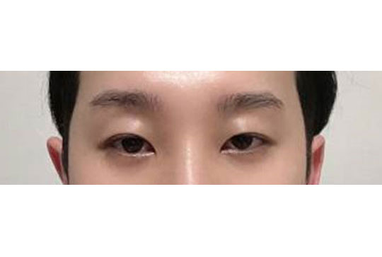 수술 6개월차 후기입니다.