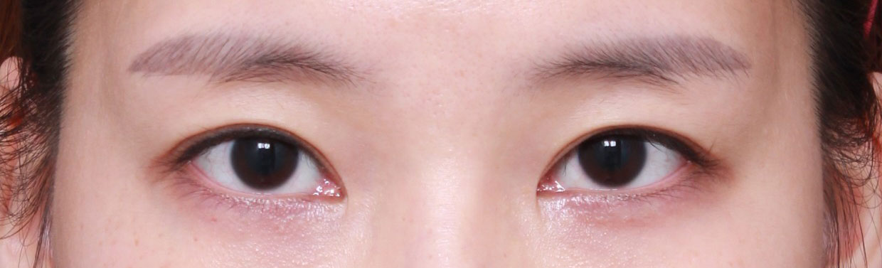 수술한지 10년째가 되니 라인도 흐려지고 좀만 부으면 한쪽은 거의  풀린것처럼 되어서 서칭해보고 찾아간 베리굿.