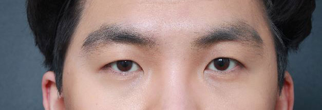 남자눈성형 이제 자신감이 생겼어요ㅎ