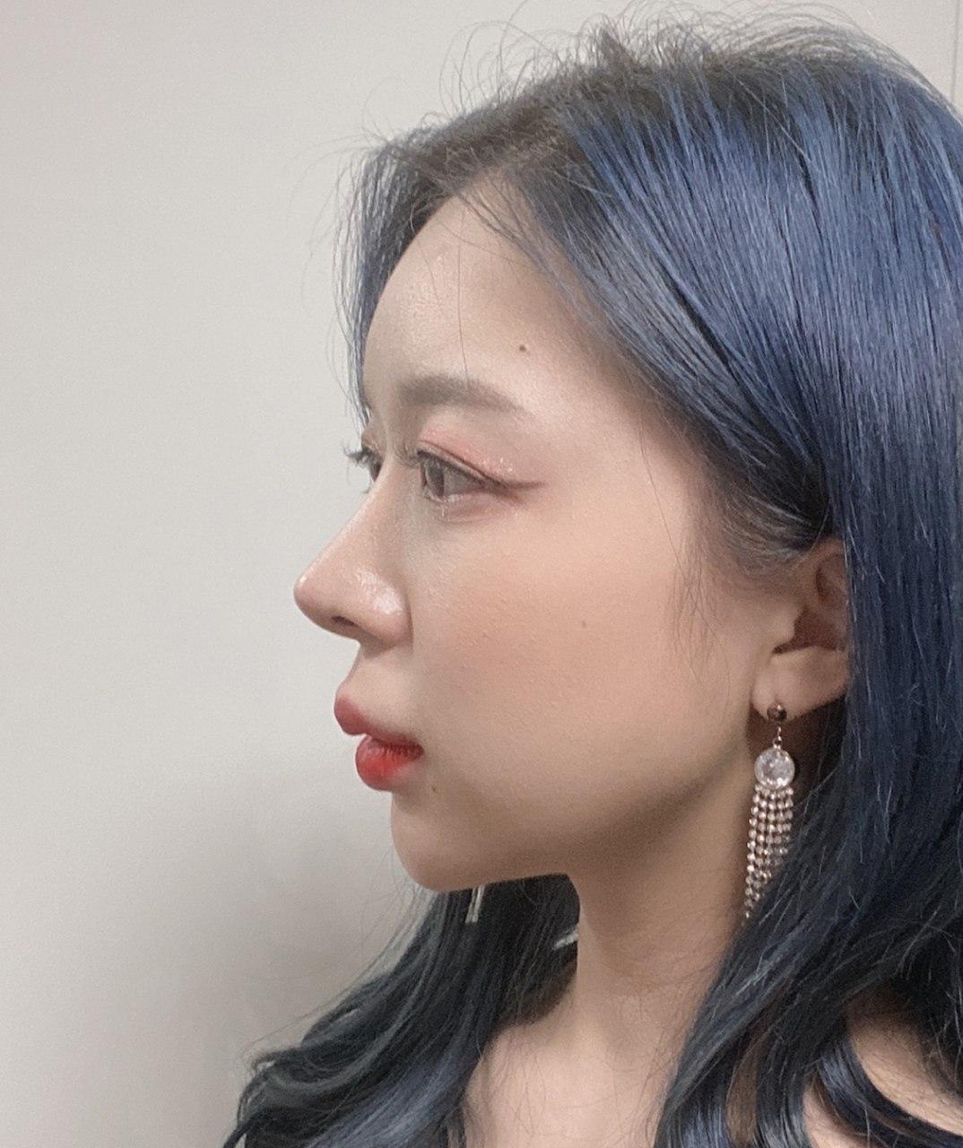 베리굿에서 매부리코 교정 9개월차 후기!