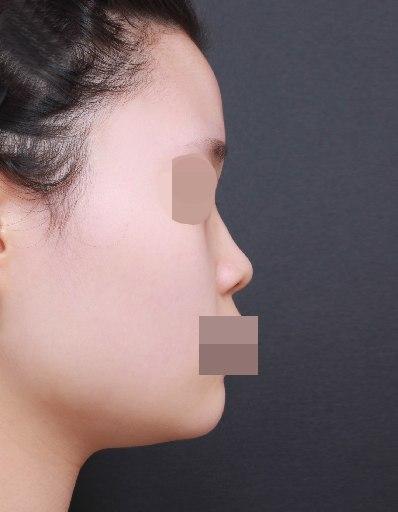 코 수술한지 한달 지난 후기입니다