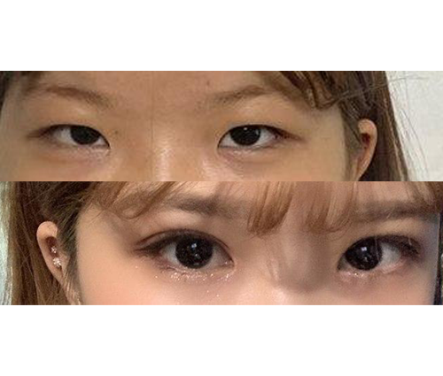 수술 너무 만족 합니다