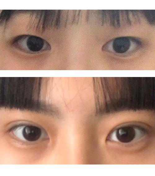 수술 후 사진은 쌍 수 한지 38일 정도 지난 눈입니다!