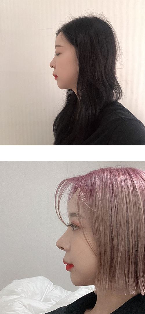 코수술6개월차 후기입니다