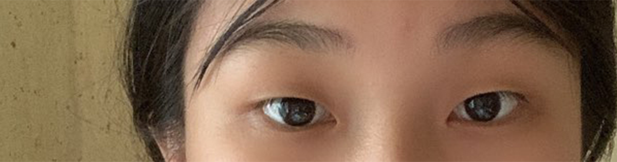 원장님도 친절하고 간호사 언니들도 친절한 베리굿에서 쌍수 했어유~~~!