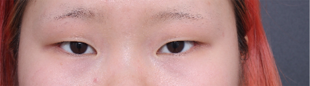 커가면서 외모에 관심이 많아져서 알아보다 후기가 좋아서 상담받고 수술 받았어용