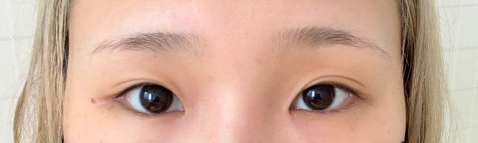 눈 재수술 베리굿에서 하였는데 눈이 확실히 트여서 조아요~후기남길게요