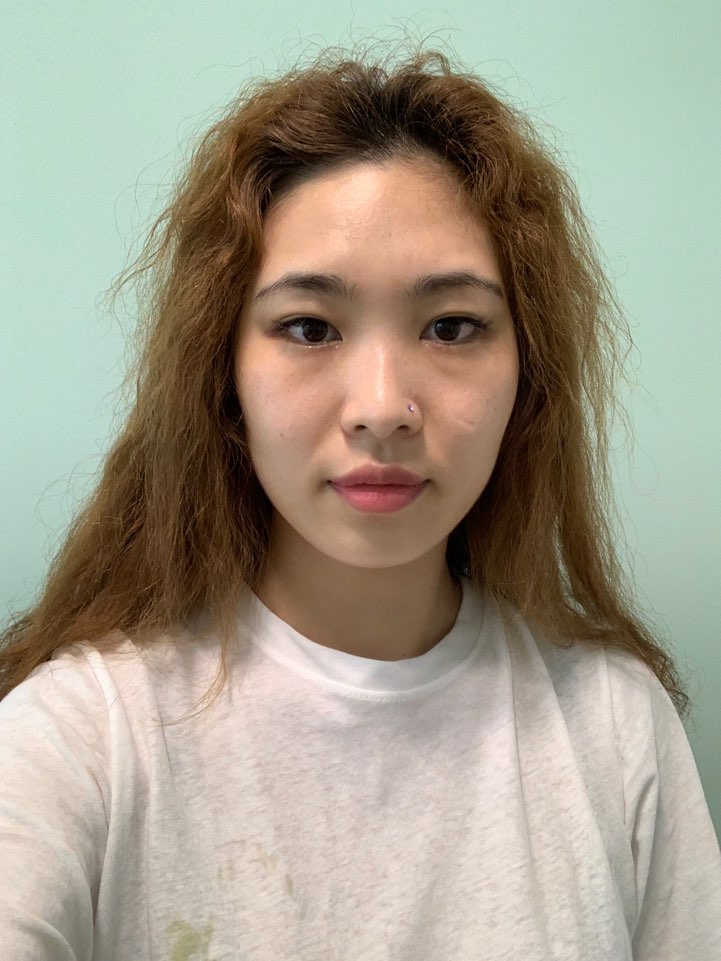 눈,코,안면윤곽 베리굿에서 수술 받았어요 후기 남깁니다~~~!!