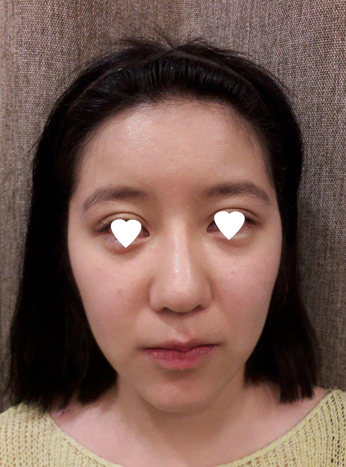 광대 긴곡선 턱끝 코재수술 했어요