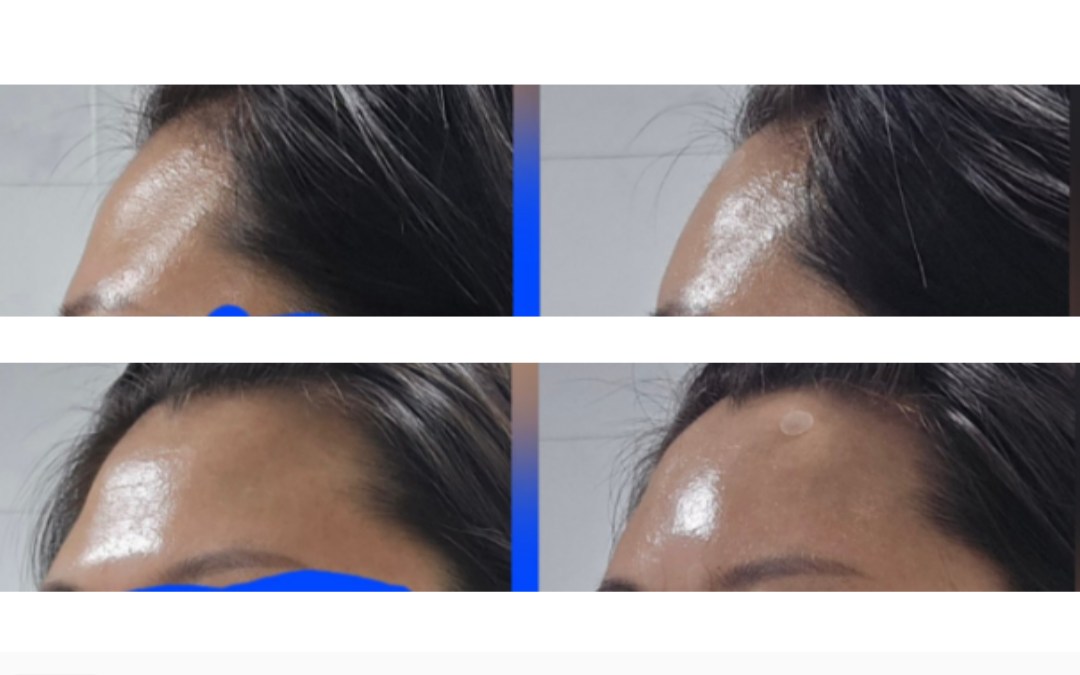 [차**고객님] 이마필러 시술후기