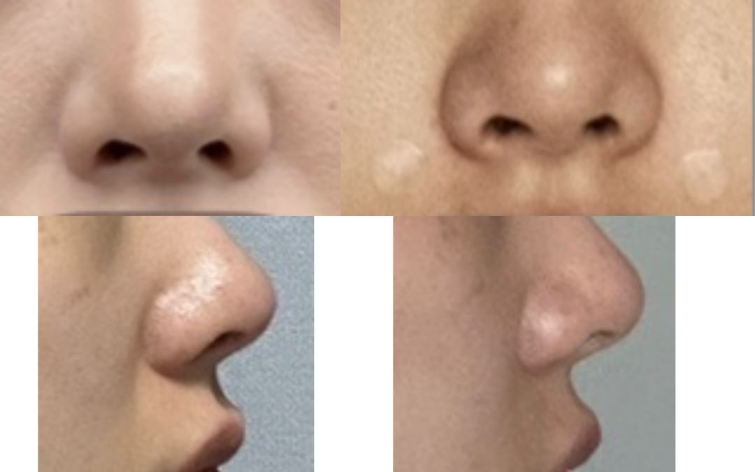 [**고객님] 팔자필러 시술후기