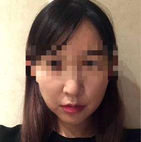 리프팅 수술후기