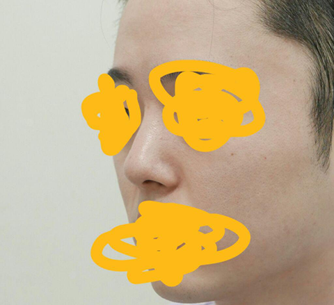 코 재수술 수술후기