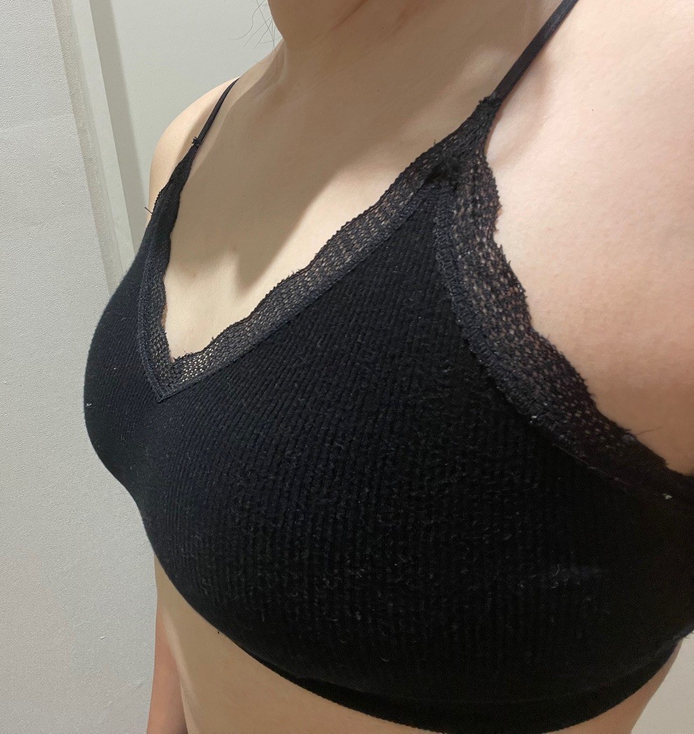 처진가슴수술 6개월차