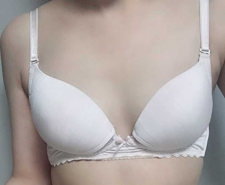 출산 후 가슴성형 했어요 !