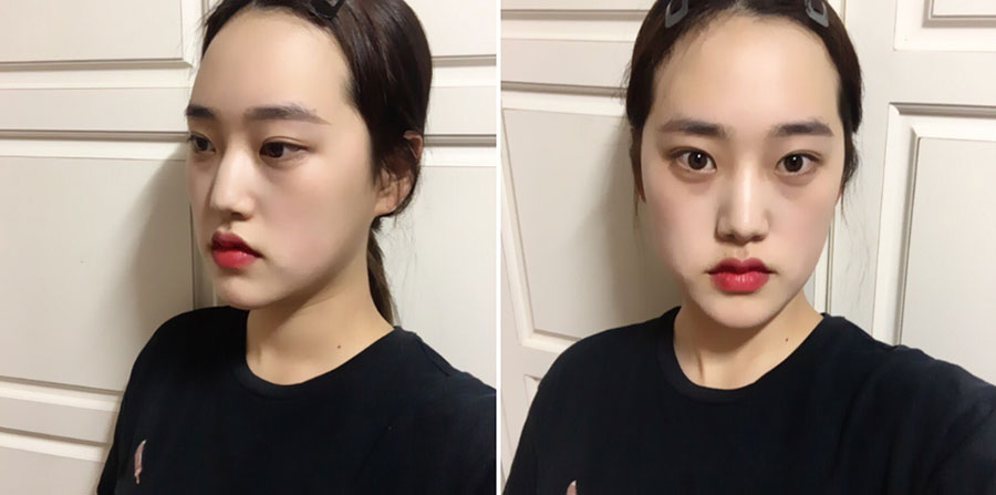 사각턱축소, 앞턱, 피질골절제술, 코 수술 이렇게 받았어요! ==== 3333