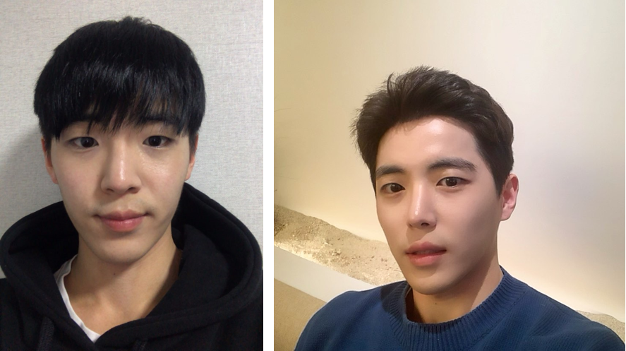 눈매교정이랑 트임, 코수술했습니다.