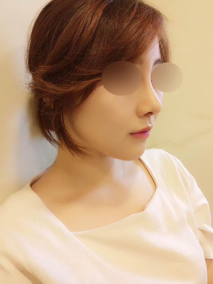 콧대, 코끝, 앞턱보형물, 비너스레이저