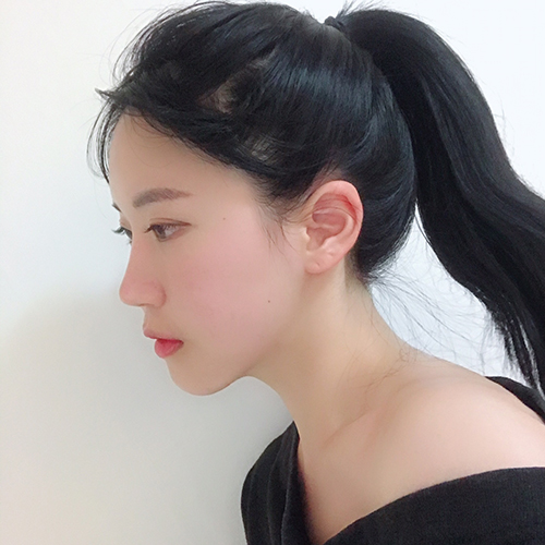 매몰재수술, 밑트임, 뒤트임, 콧대, 코끝, 매부리코, 절골, 윤곽4종