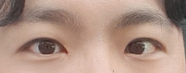 남자 눈매교정(앞트임포함, 절개)했어요~!!