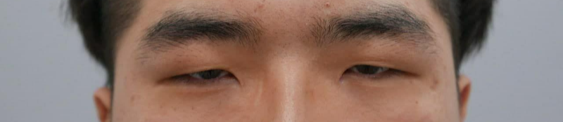 쌍꺼풀(절개), 눈매교정, 앞트임