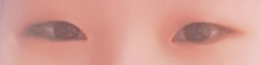 제이준성형외과에서 박형준 원장님께 쌍커풀 눈매교정 수술 받았습니다!!