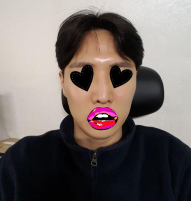 내시경이마거상(엔도타인), 코재수술(콧대,코끝), 휜코교정, 비공내리기