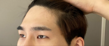 눈매교정이랑 이마거상 받은 '5개월 경과 후기입니다!