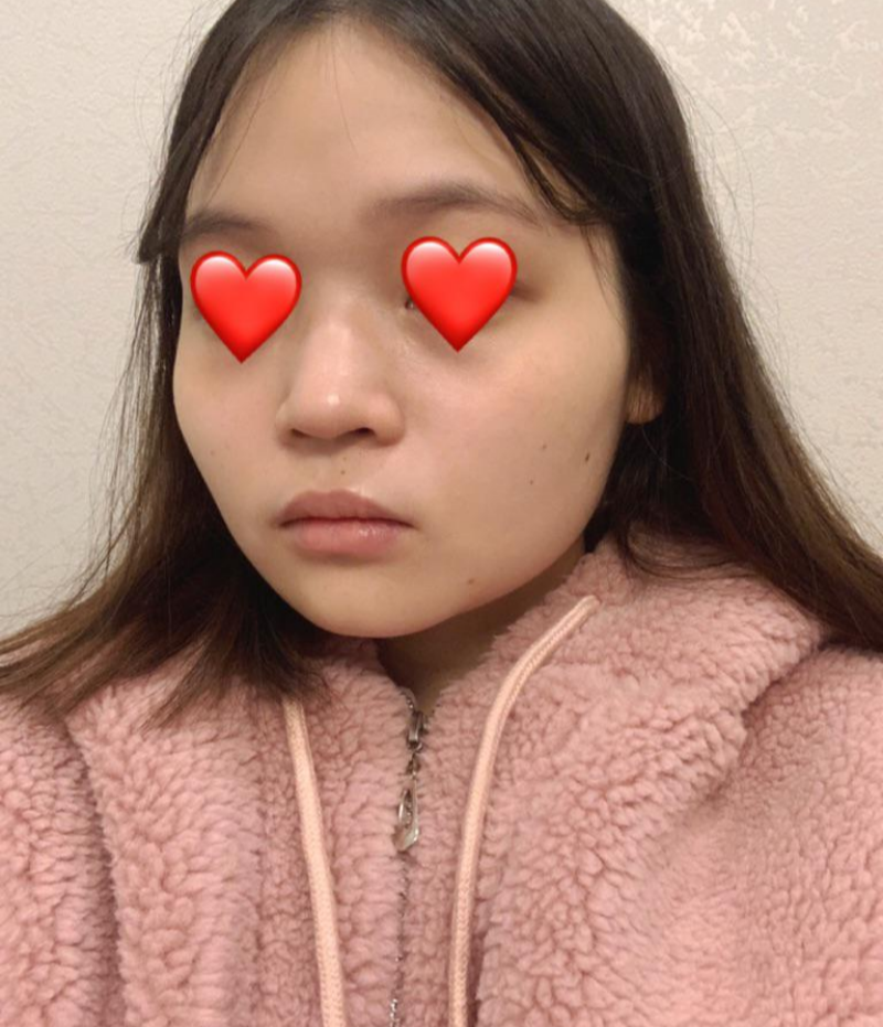 안면윤곽+코한지 3개월 넘어가네요!