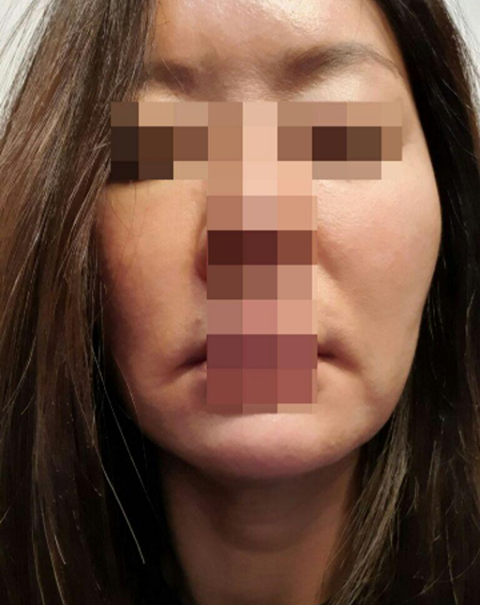 눈밑지방이식, 안면거상술