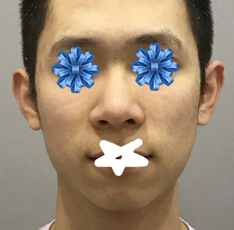 남자 코,윤곽 성형 후기 남깁니다