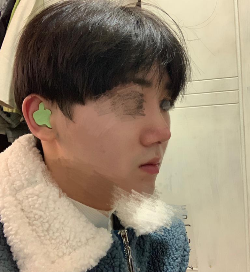 코재수술(콧대, 코끝), 콧날개축소