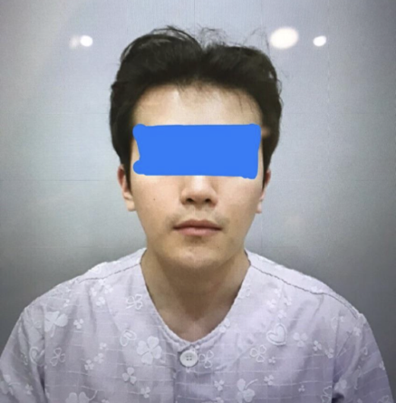 사각턱, 광대축소, 앞턱, 피질절골, 비너스레이저, 윤곽주사