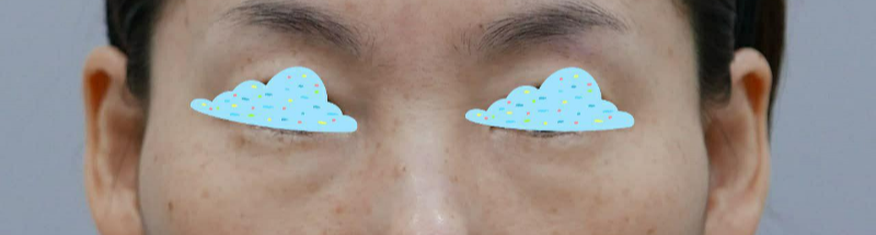 하안검 후기입니다~