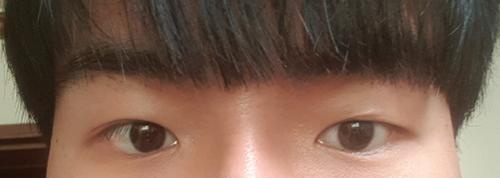 부분절개 눈매교정 재수술