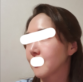 안면거상 재수술 받고 옛사진보니 뿌듯^^