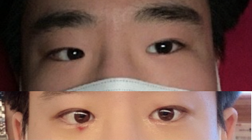 쌍꺼풀(매몰), 앞트임