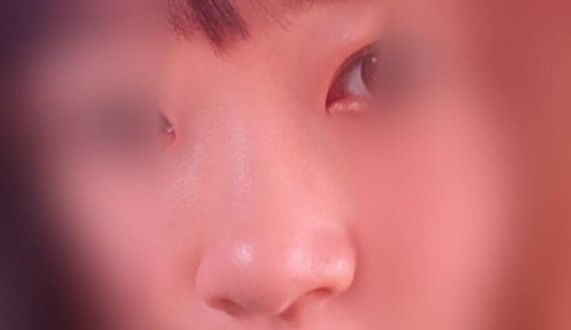 제이준성형외과에서 코 필러 맞았어요:)